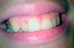 cofnięty prawy siekacz boczny