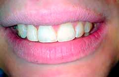 nałożona licówka kompozytowa bez uszkadzania zęba