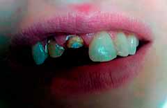 złamane, martwe, ciemne zęby