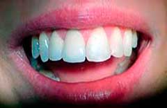 założona korona porcelanowa